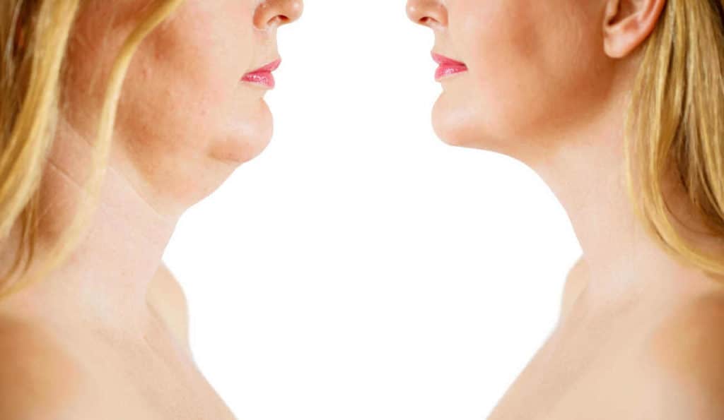 Double Chin treatment West Brompton before and after results