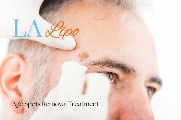 What Are the Most Effective Treatments for Age Spots West Brompton?