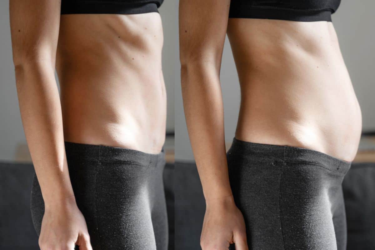 How long does diastasis recti take to improve West Brompton?