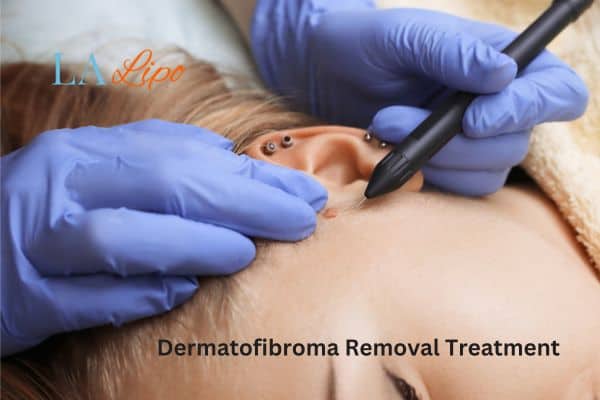 Dermatofibroma Removal Treatment West Brompton