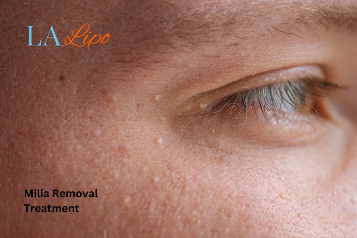 Cryopen Milia Removal: Is It the Easiest and Safest Option West Brompton?