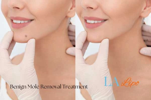woman's before and after mole removal West Brompton results