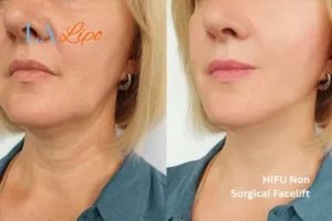 hi-fu for wrinkles West Brompton before and after results