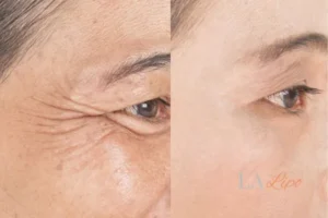 Before and after results of woman - HI-fu wrinkles reduction treatment West Brompton