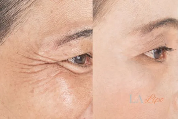 Before and after results of woman - HI-fu wrinkles reduction treatment West Brompton