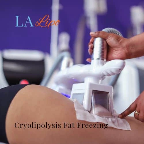 fat freezing - Cryolipolysis West Brompton