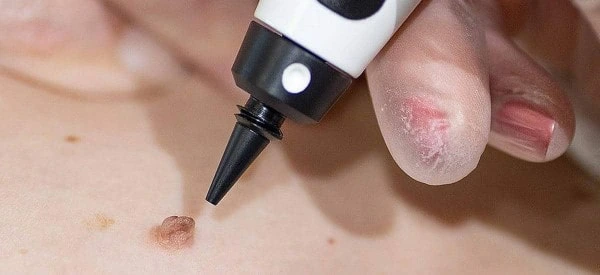 skin tag removal using cryopen West Brompton