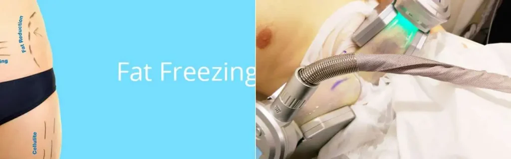 multi areas of a persons body having coolsculpting West Brompton treatment