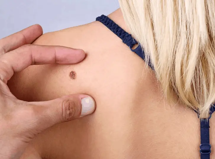 woman having mole removal West Brompton consultation before treatment.