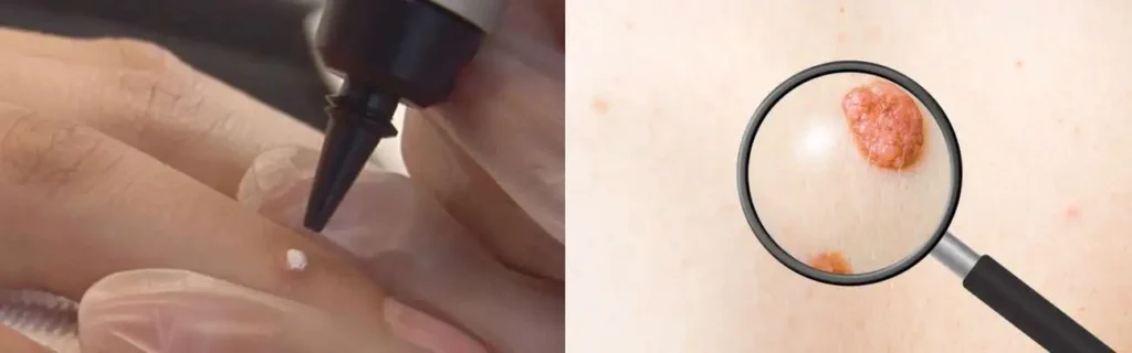 Cryopen for mole removal West Brompton - speak to our team today!