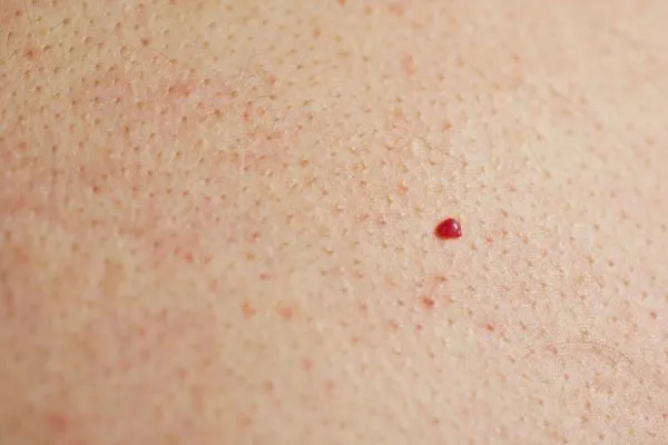 close up of a cherry angioma West Brompton