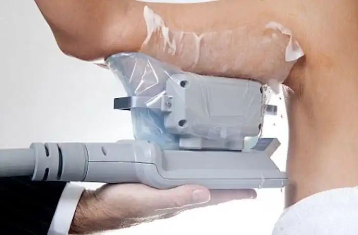 Picture of fat freezing West Brompton on the upper arms.