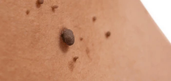 image of a skin tag West Brompton