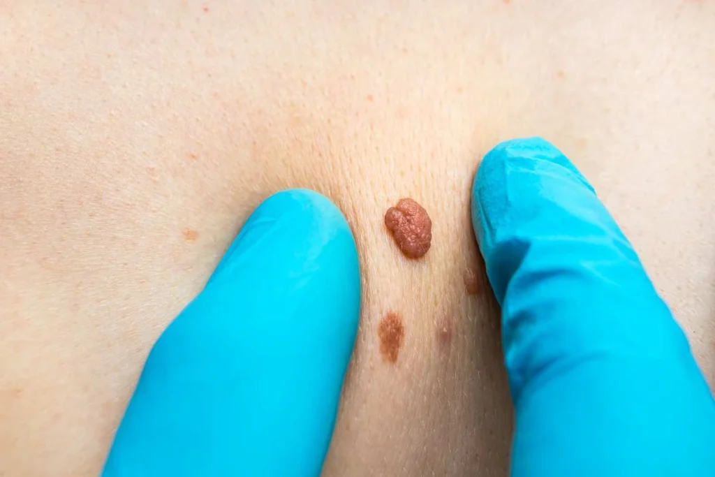 Consultant examining a skin tag West Brompton