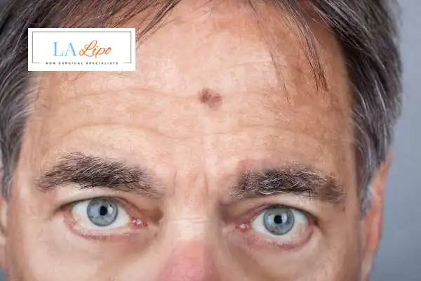 Solar Lentigo Removal West Brompton image of man with mark on his forehead