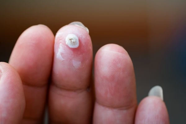 wart on person finger - cryotherapy to treat from LA LIPO West Brompton
