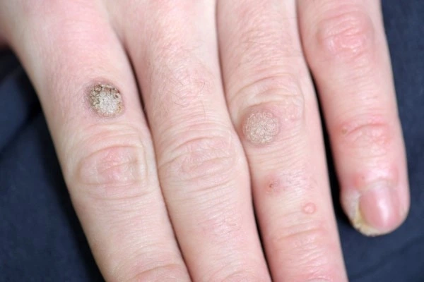photo of warts on person hand - see wart removal West Brompton from LA LIPO