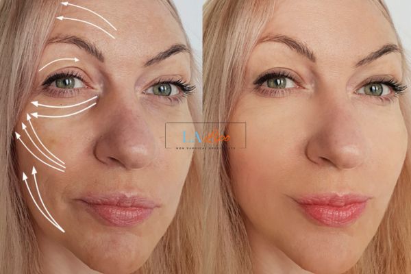 Morpheus 8 results West Brompton face lift.