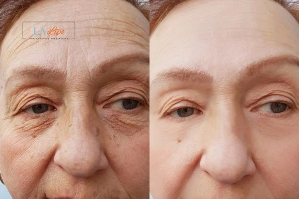 The powerful benefits of Morpheus8 Treatment West Brompton - Call Our team today!