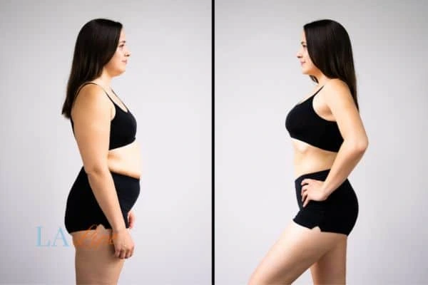 Picture of womans before and after using LA-EMS body sculpting to improve her core strength West Brompton