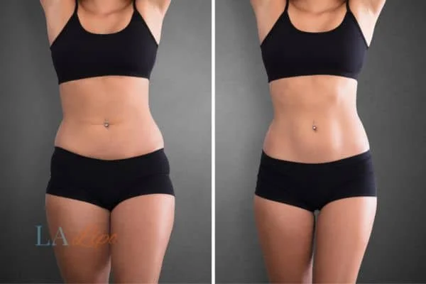 before and after results of non-surgical treatment to help a woman's body image and mental health West Brompton