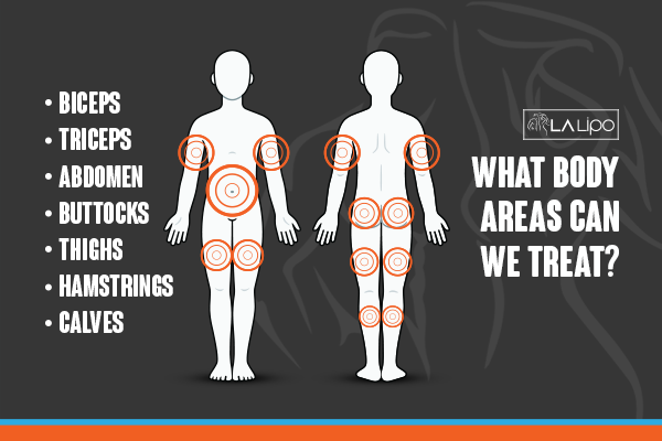 Diagram to show areas you can have LA-EMS Body Sculpting Treatment West Brompton