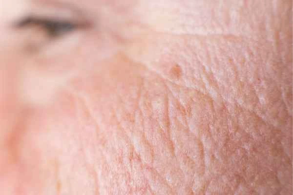 close up picture of a woman's face showing an age spot West Brompton