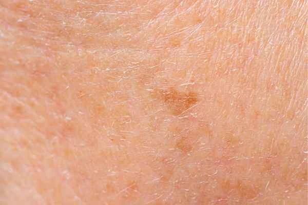 close up picture of age spots West Brompton