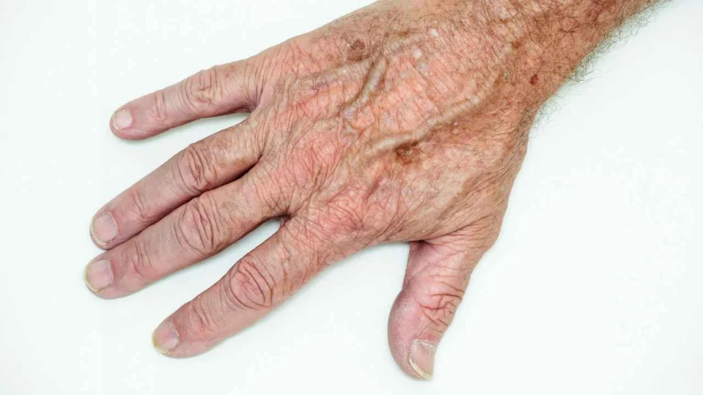 Male hand showing age spot West Brompton
