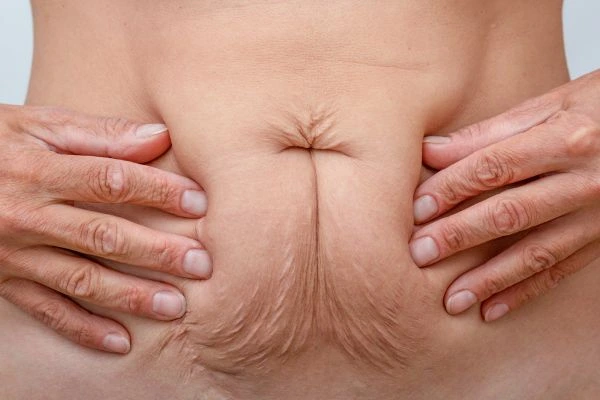 Image of a woman's stomach with loose skin - example of skin tightening West Brompton options