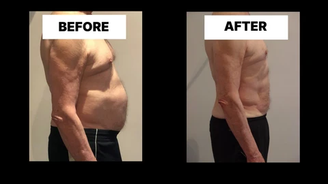 What Symptoms Can Diastasis Recti Cause in Men? Weak Core, Back Pain and Poor Posture West Brompton